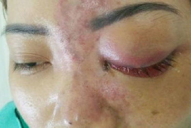 Vợ mù mắt vì chồng không bằng cấp tiêm filler