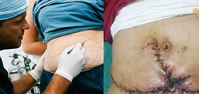 Hút mỡ bụng giảm béo có thể tử vong vì những biến chứng nguy hiểm