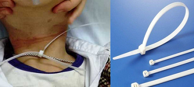 Trẻ suýt tử vong vì dây nhựa quấn cổ, bác sĩ cảnh báo an toàn