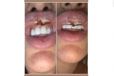 Cô gái suýt mất đôi môi vì tiêm chất làm đầy vào động mạch
