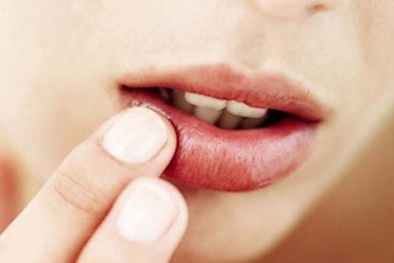 Những cách đơn giản 'cứu' đôi môi không bị nứt nẻ vào mùa Đông