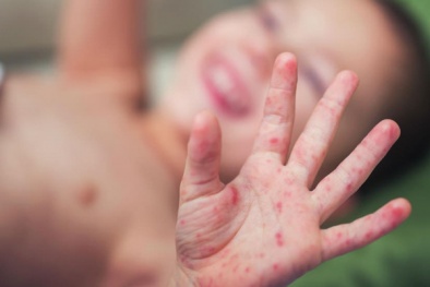 Chuyên gia y tế cảnh báo bệnh sởi bùng phát và cách phòng ngừa