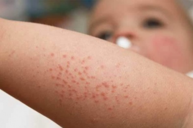 Cẩn trọng dị ứng da vào mùa đông