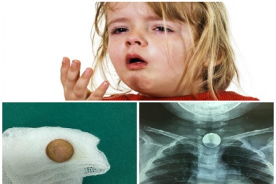 Trẻ hóc đồng xu do đùa nghịch, Tết đến cha mẹ càng nên cảnh giác