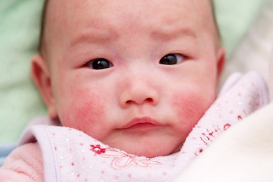 3 bệnh ngoài da thường gặp nhất vào mùa đông và cách phòng tránh