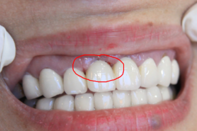 Cảnh báo biến chứng khi bọc răng sứ sai chỉ định