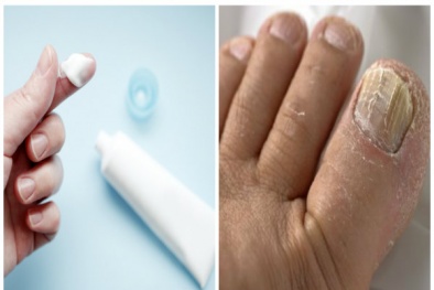 Dùng thuốc chống nấm ketoconazol cần hết sức thận trọng