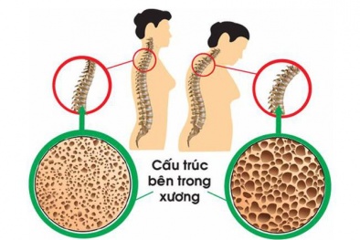 3 dấu hiệu cảnh báo cơ thể bạn đang thiếu canxi trầm trọng