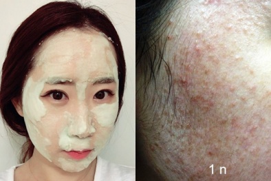 Dùng sữa rửa mặt sai cách có thể khiến da mặt 'biến dạng'