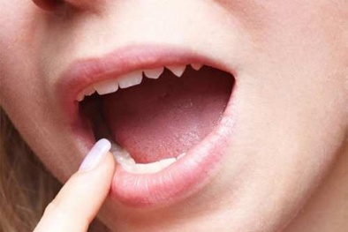 Tìm ra 'thủ phạm' mới gây bệnh ung thư miệng, người dân cần cẩn trọng