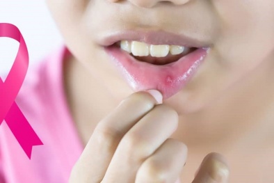 Ung thư miệng: Các triệu chứng phức tạp và cách phòng tránh