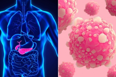 Ung thư tuyến tụy: Kẻ sát nhân thầm lặng
