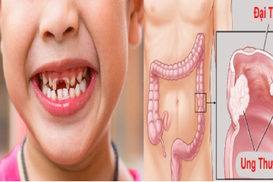 Bệnh nhân ung thư đại tràng sẽ gần 'tử thần' hơn nếu không đề phòng loại vi khuẩn này