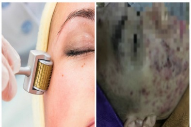Mặt cô gái mọc mụn mủ dày đặc sau lăn kim, nhiều biến chứng còn đáng sợ hơn