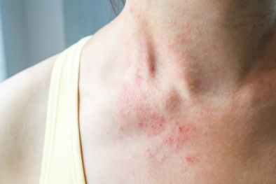 Bị dị ứng với răng giả bằng niken khiến người phụ nữ phát bệnh chàm