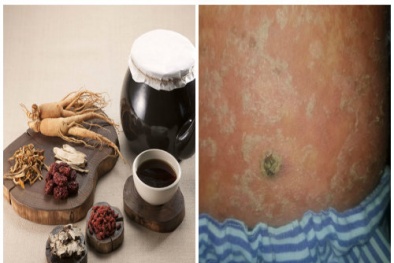 Bị ung thư da do nhiều năm uống thuốc đông y không rõ nguồn gốc