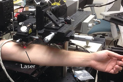 Công nghệ laser độc đáo giúp phát hiện sớm tế bào ung thư, ngăn ngừa di căn