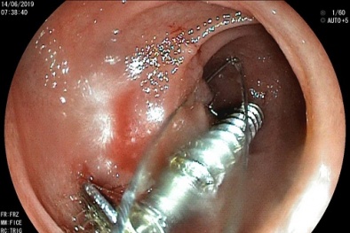 Rợn người, chiếc đinh vít sắc nhọn 3,5 cm trong tá tràng bé 2 tuổi