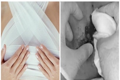 Chỉ sau vài ngày tiêm chất làm đầy, ngực người phụ nữ đã bị sưng và đầy mủ