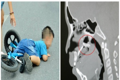Bé trai thủng vòm họng do ngã xe đạp, những sai lầm nhiều cha mẹ mắc khi dạy con tập đi