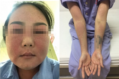 Cô gái nhập viện cấp cứu vì bôi kem trắng da
