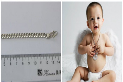 Bé trai phải nhập viện khẩn cấp vì khó thở do nuốt vòng bạc đeo trên cổ
