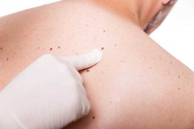 Bào chế thành công vắc xin nano 'khắc chế' ung thư da