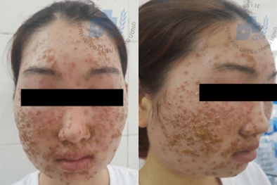 Dùng bột rửa mặt mua trên mạng cô gái 22 tuổi viêm da mặt, chảy dịch vàng