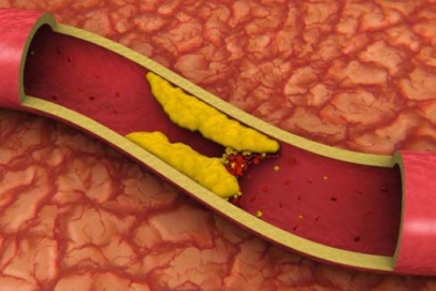 Nghiên cứu tìm ra nồng độ 'cholesterol xấu xí' cao gây phiền toái