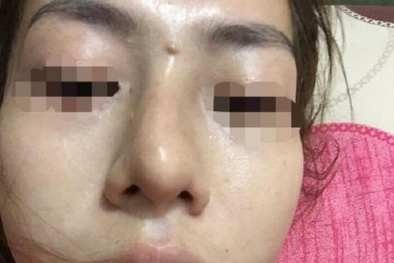 Bé gái 13 tuổi mù mắt sau khi trốn gia đình tiêm chất làm đầy nâng mũi