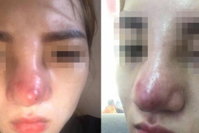 Suýt mù mắt, biến dạng mặt vì tiêm phải 'filler bẩn' tại thẩm mỹ viện