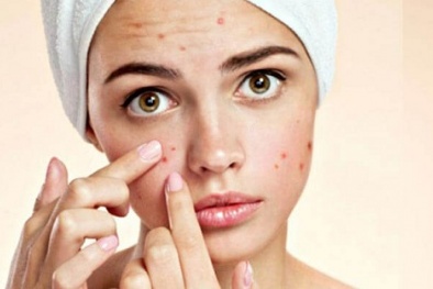 Lạm dụng mỹ phẩm, coi chừng tự 'rước' mụn trên da
