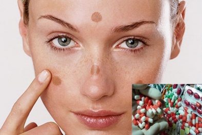 Tự ý dùng thuốc điều trị nám, tàn nhang có thể gây ung thư da, vô sinh