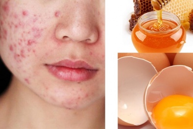 Làm mặt nạ tự chế từ mật ong với trứng gà khiến mặt sưng tấy, nổi mụn mủ