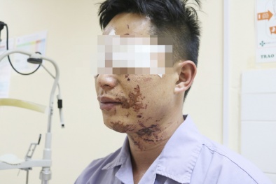 Bình ga mini phát nổ trong lúc ăn lẩu khiến người đàn ông bị bỏng khắp mặt