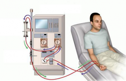 Chạy thận nhân tạo: Những tai biến rủi ro ai cũng phải biết