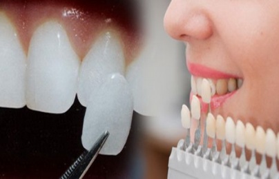 Trào lưu gắn răng khểnh làm đẹp: Coi chừng rước họa vào thân!