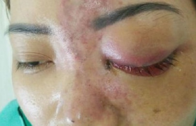 Vợ mù mắt vì chồng không bằng cấp tiêm filler