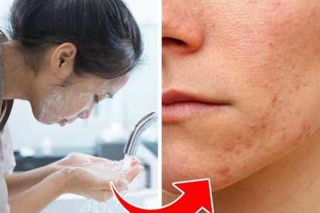 Dùng khăn giấy tẩy trang, sản phẩm dưỡng tóc nhiều cũng có thể gây mụn