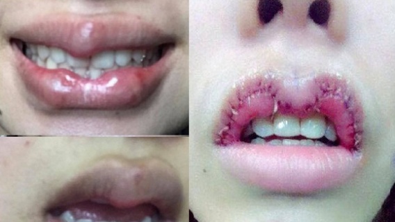 Tạo hình môi trái tim: Coi chừng dị dạng