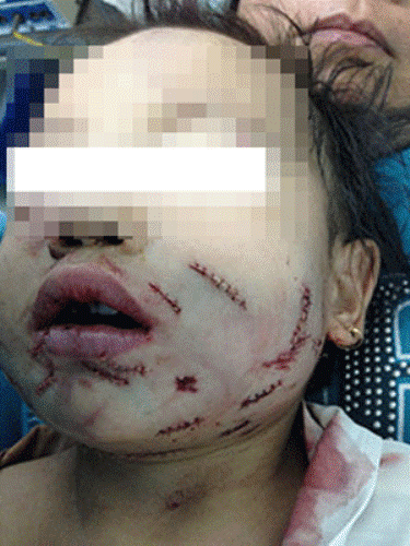 TP.HCM: Trẻ 8 tuổi bị chó nhà cắn đến nát mặt