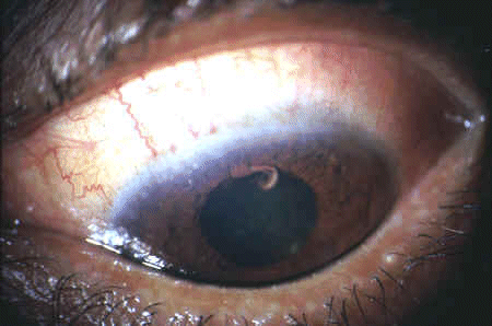 Đắp ếch nhái sống, sán ngoe nguẩy trong mi mắt