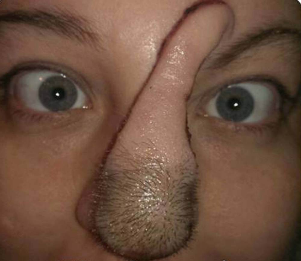 Một người phụ nữ được cấy ghép mũi từ chính da đầu của cô ấy là một câu chuyện lạ có thật tại bang Illinois (Mỹ)