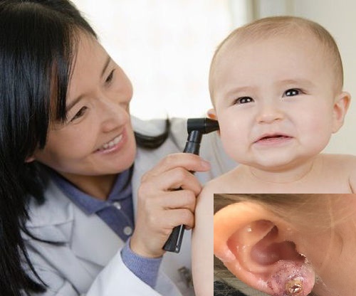  Bấm lỗ tai cho trẻ ngay từ khi còn nhỏ tiềm ẩn nhiều nguy cơ