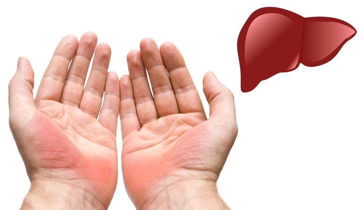Lòng bàn tay bỗng dưng xuất hiện màu đỏ rất có thể bạn đang có vấn đề về gan