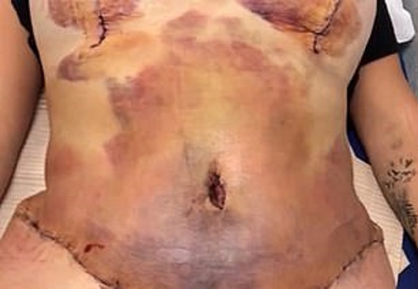 Người phụ nữ suýt chết sau cuộc đại phẫu thuật thẩm mỹ cắt bỏ da thừa