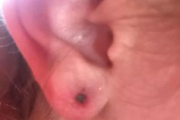 Bé gái 10 tuổi bị nhiễm trùng huyết do xỏ khuyên tai