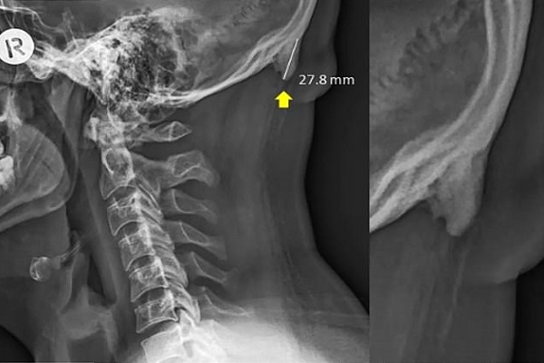 Sử dụng điện thoại nhiều có thể phát triển xương thừa sau gáy