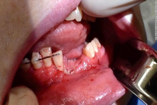 Thanh niên hút thuốc lá điện tử bị nổ vỡ hàm