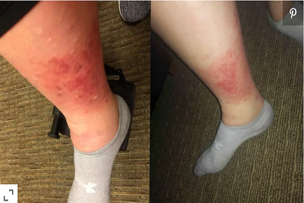 Cô gái suýt mất chân do nhiễm trùng nước trong bồn tắm khách sạn